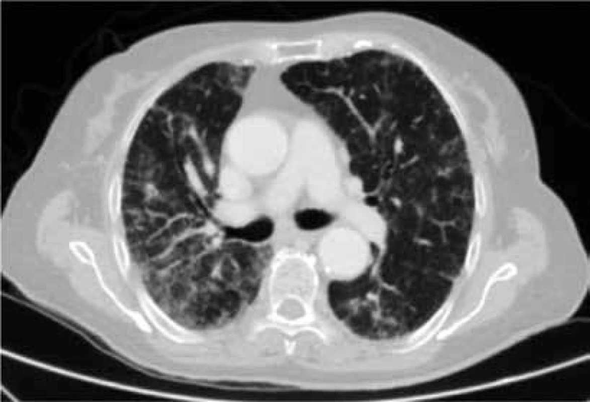 CMV pneumonie