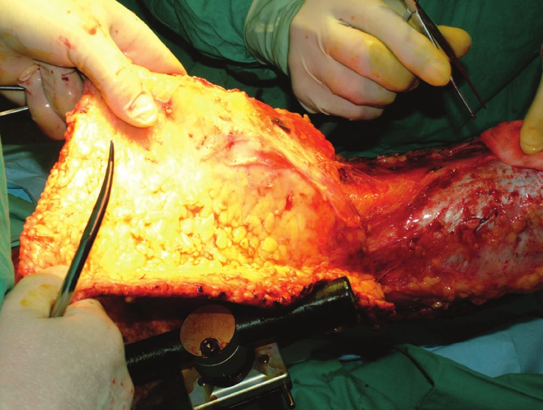Epifasciální nekrektomie avulzí kůže s podkožím na dolní končetině