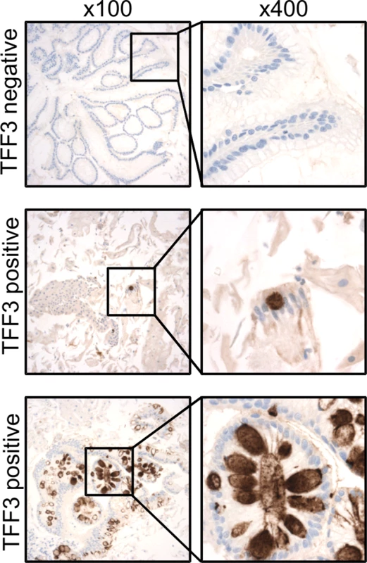 TFF3 immunohistochemical staining of Cytosponge samples.