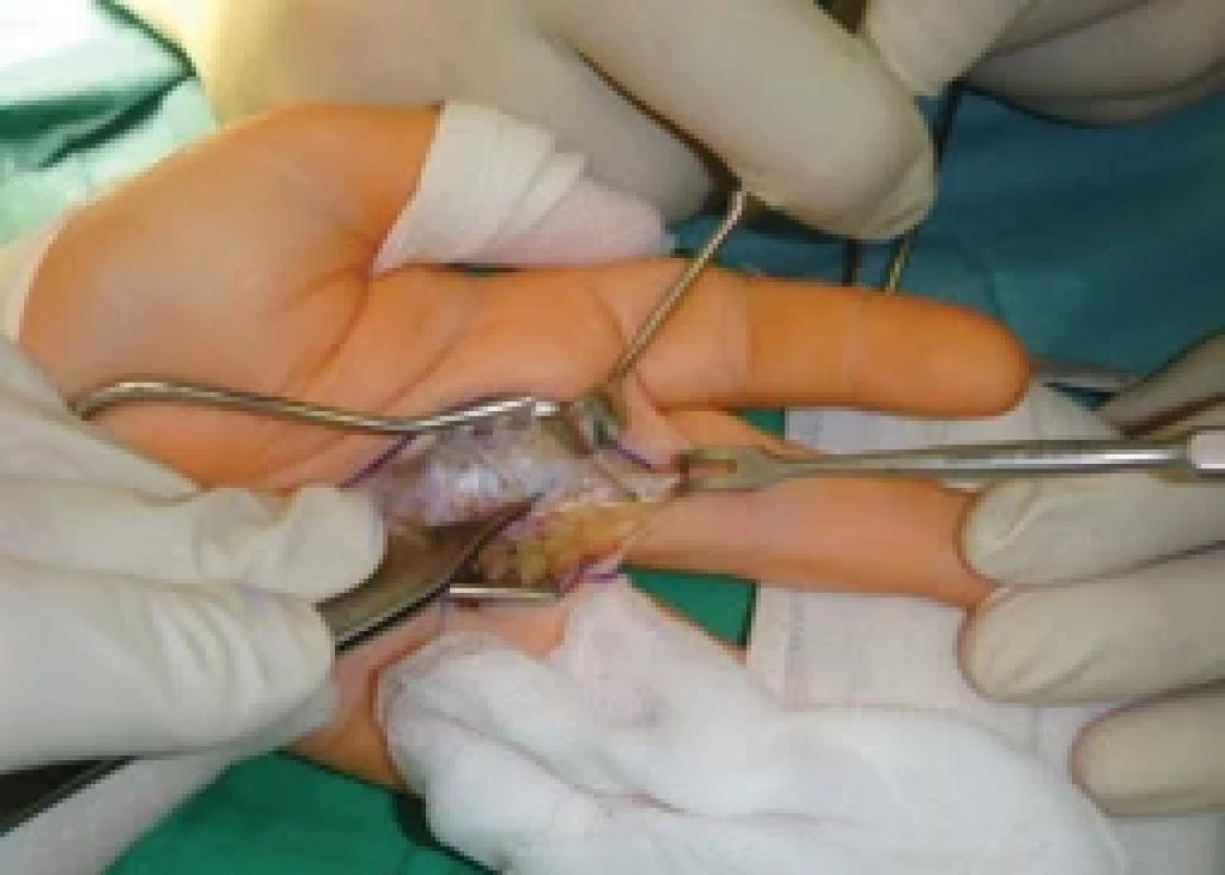 Unilateral release of the A1 pulley.