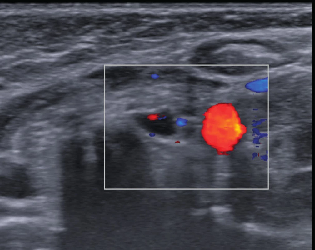 Ultrasonografické vyšetrenie prištítnych teliesok. 
Fig. 1. Ultrasonography of parathyroid glands. A. Hypoechoic oval mass 5.1 x 4.5 mm of size under the left lobe of thyroid gland; appearance typical for lymph node. B. Color-doppler shows central hilar vascularization.