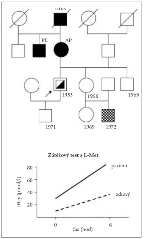 Rodokmen pacienta s hyperhomocysteinemií z deficitu vitaminu B<sub>12</sub> pri akutním infarktu myokardu. Vpravo pozitivní výsledek zátežového testu pacienta s L-methioninem za 6 hod.