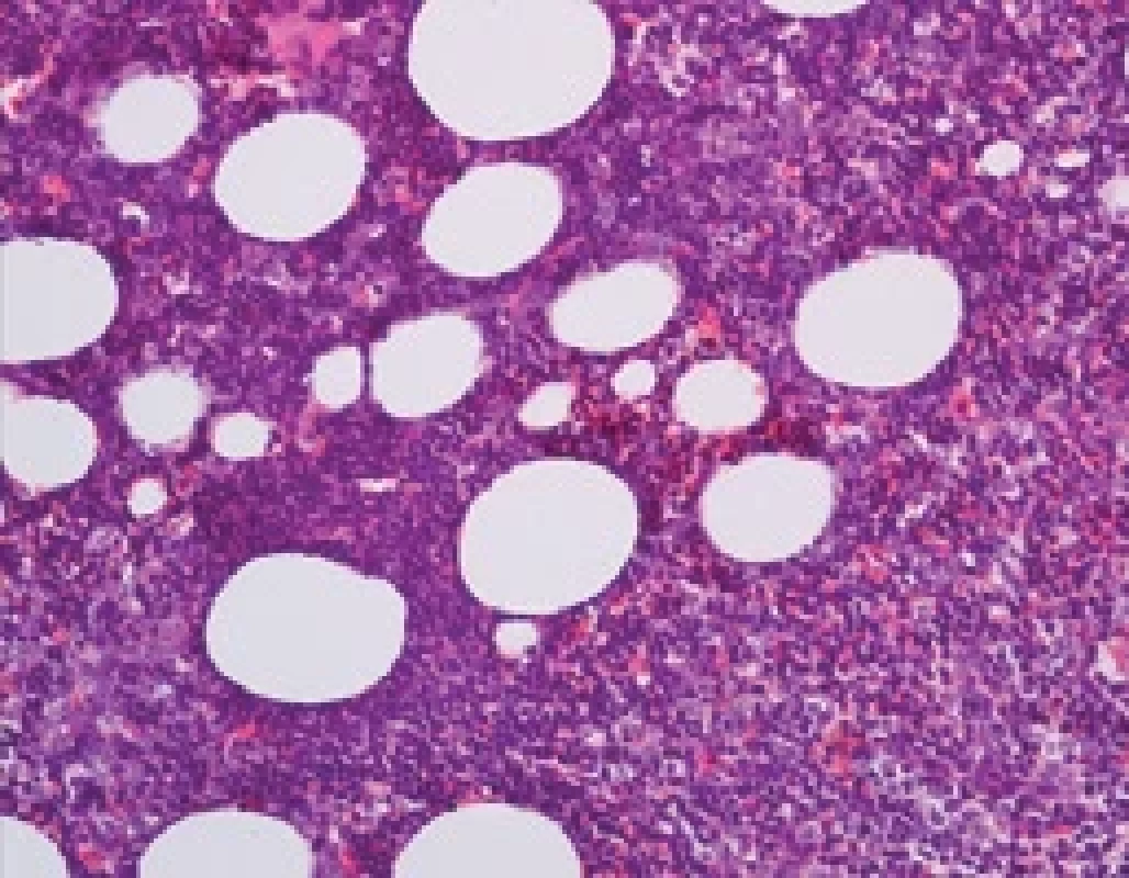 Histologie kostní dřeně před léčbou (FNHK, Fingerlandův ústav patologie) Vzhledem k věku zvýšená celularita kostní dřeně, která připadá na vrub infi ltraci CLL. V imunohistochemickém vyšetření až 50 % buněk s fenotypem CLL, 15 % blastů (pozitivita CD34).