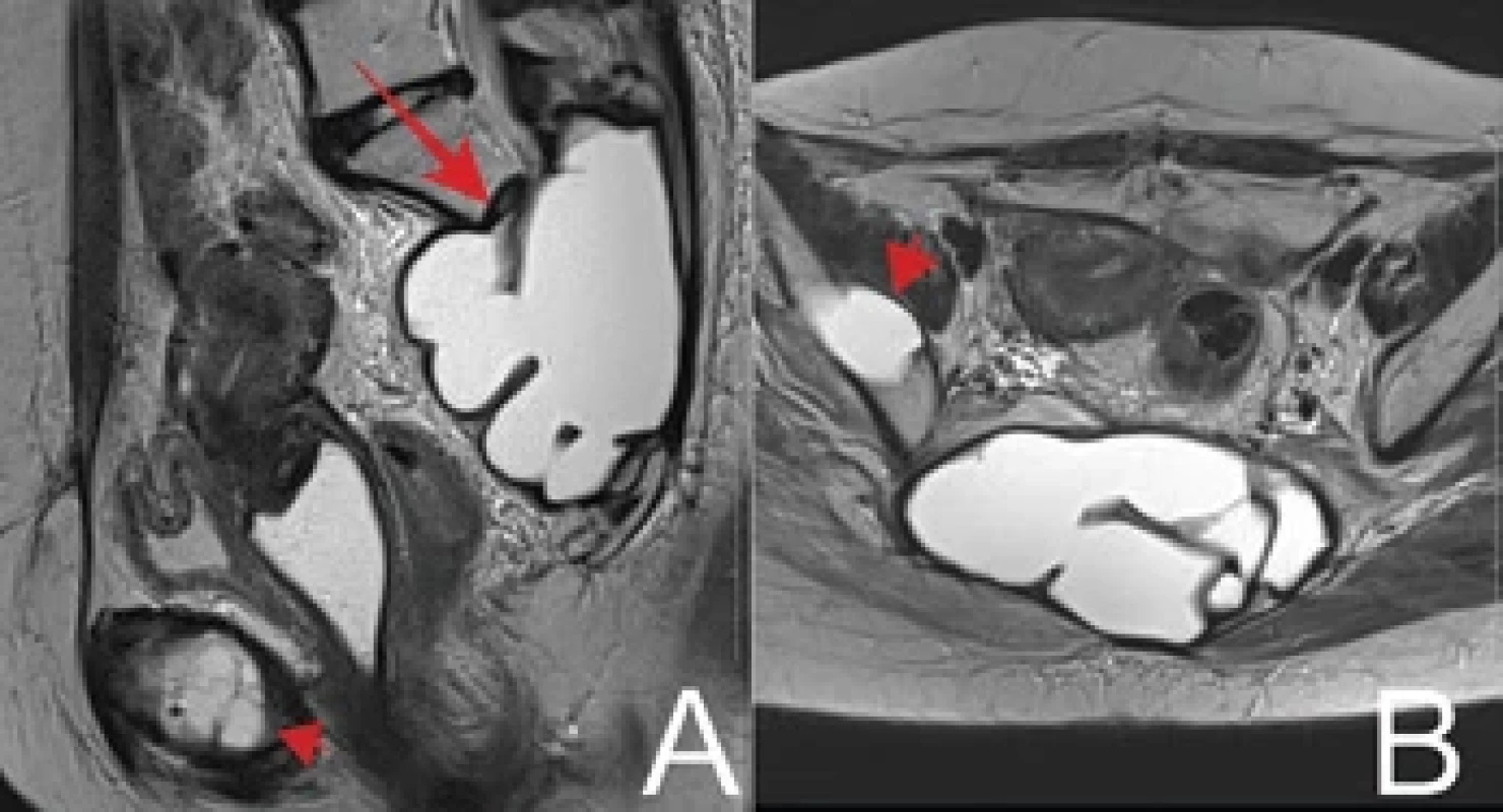 Magnetic resonance imaging (MRI), TSE/T2 weighting, in the sagittal (A) and axial (B) planes. On MRI, the best delimitation of the predominantly cystic osteolytic lesion is observed, with a predominantly homogeneous signal (arrow in A). The involvement of the pubic bone (arrowhead in A) and the iliac bone on the right (arrowhead in B) can also be seen. In both images, the uterus has preserved signal and morphology.