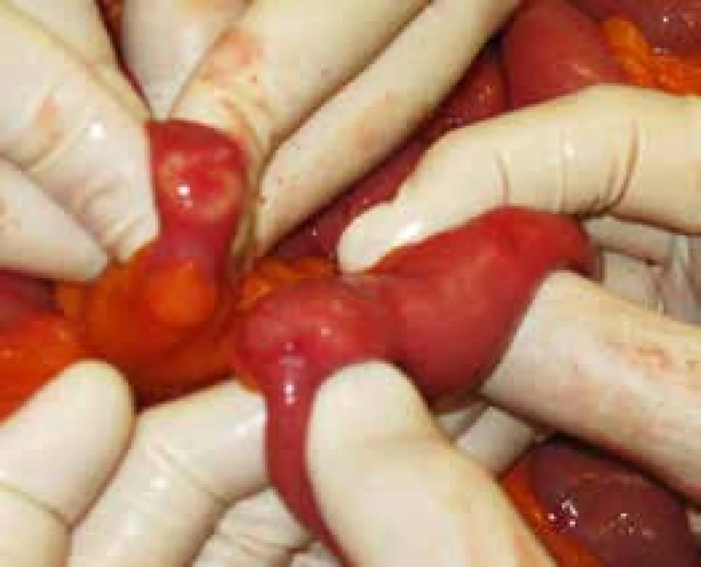 Peroperative view of 2 round-shaped lesions