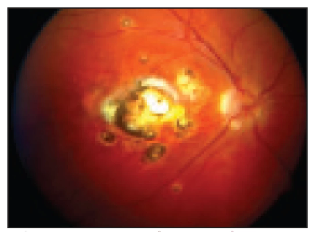 Kongenitální toxoplazmová chorioretinitis. V centru sítnice velké staré pigmentované ložisko, v jeho okolí několik drobných „satelitních“ ložisek.