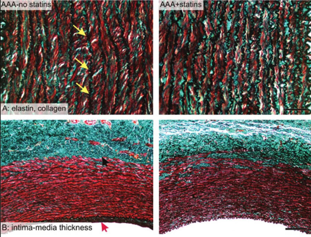 Srovnání histologických preparátů; barvení trichrom; žluté šipky ukazují černě nabarvená vlákna elastinu
Fig. 1: Comparison of histological sections; trichrome staining; yellow arrows show black coloured elastin fibres