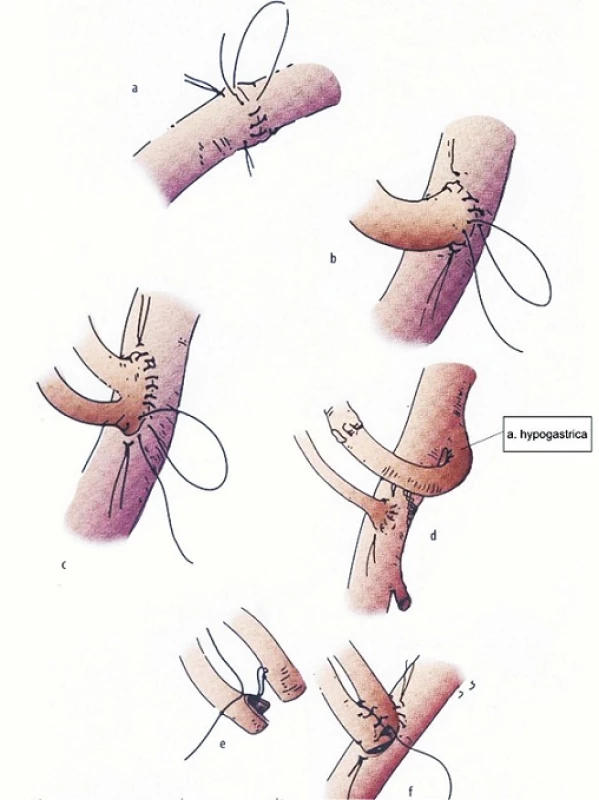 Možnosti rekonštrukcie renálnych artérií [12]
Fig. 6: Reconstruction options in renal arteries [12]