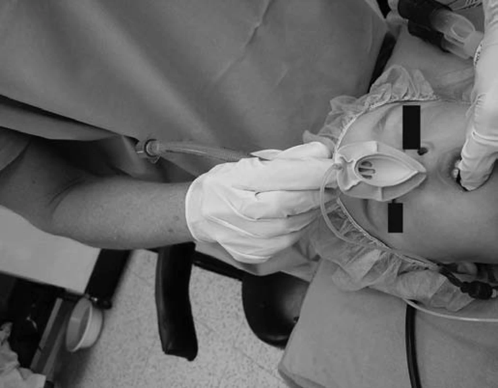 Intubace laryngeální maskou.
Fig. 8. Laryngeal mask airway.