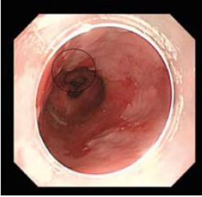 Časný adenokarcinom, standardní zobrazení.
Fig. 1. Early adenocarcinoma, white light endoscopy.