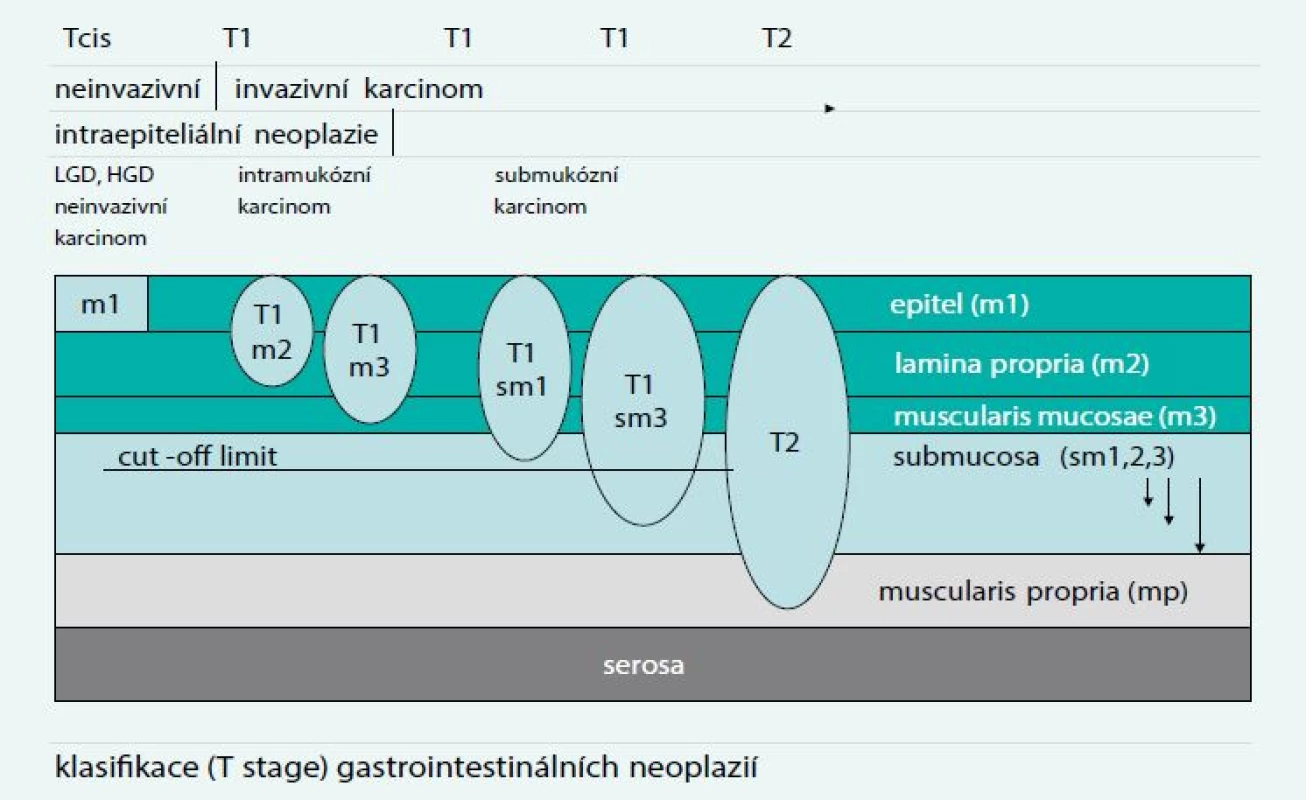 TNM klasifikace a možnosti endoskopické resekce. Upraveno podle [6]