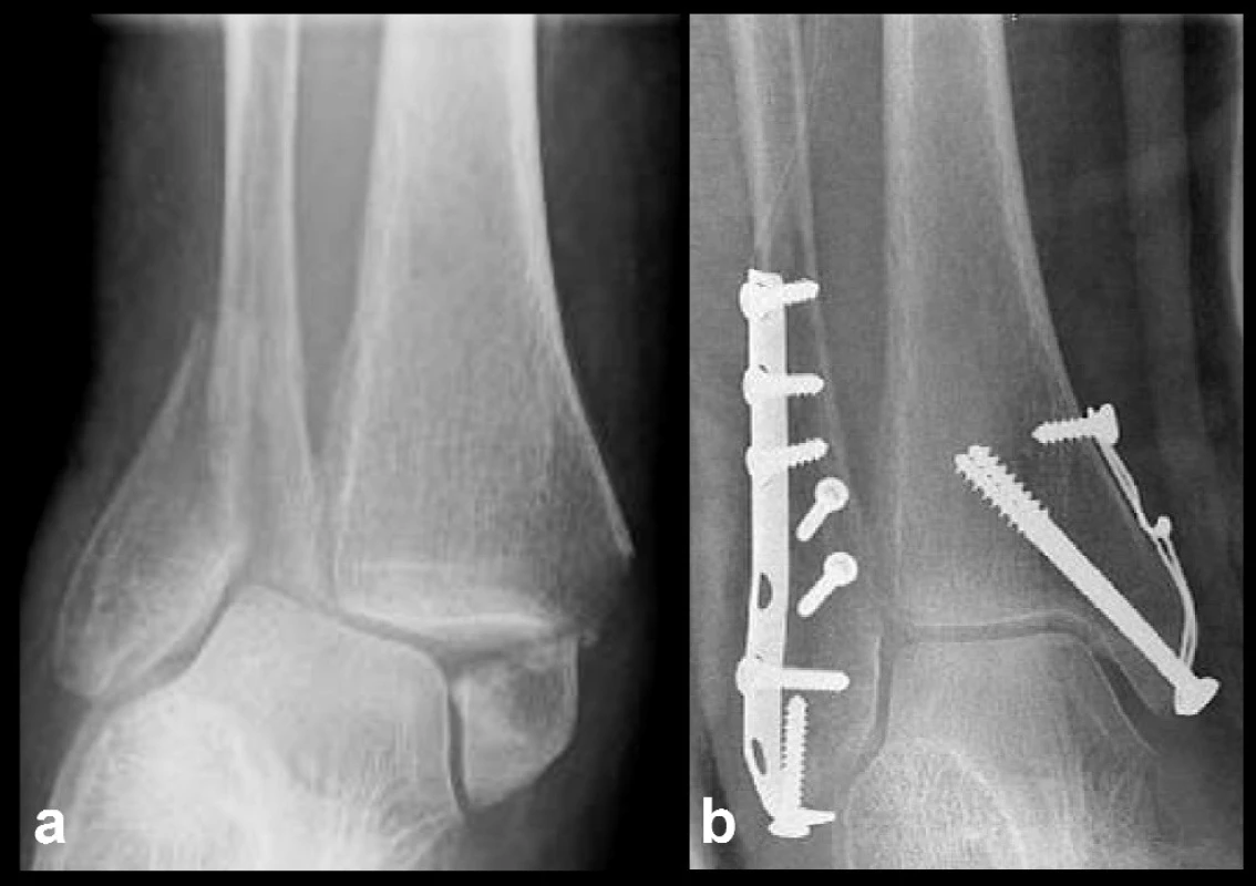 Osteosyntéza vnitřního kotníku kombinací tahových šroubů a cerkláže a – stav před operací, b – stav po operaci 