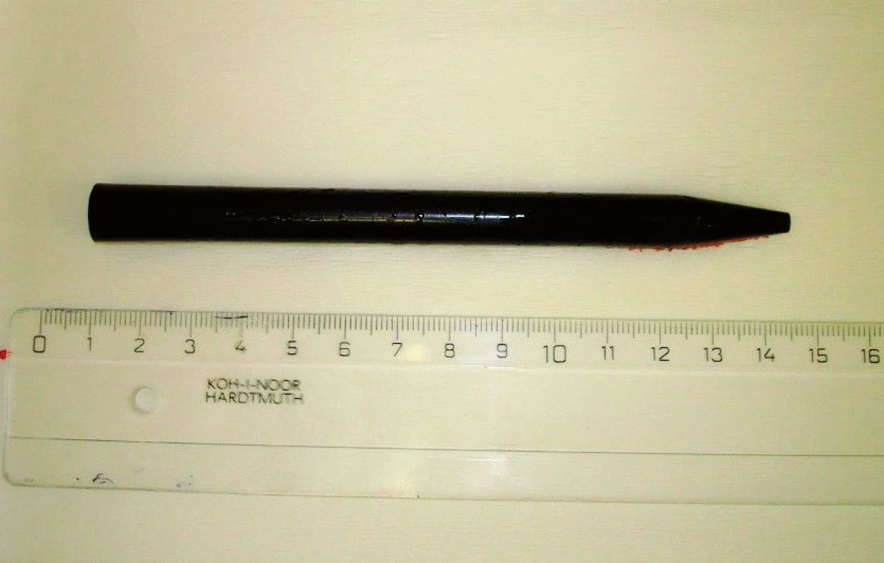 Propisovací tužka extrahovaná z uretry u pacienta 5
Fig. 5. Extracted pen from urethra by patient 5