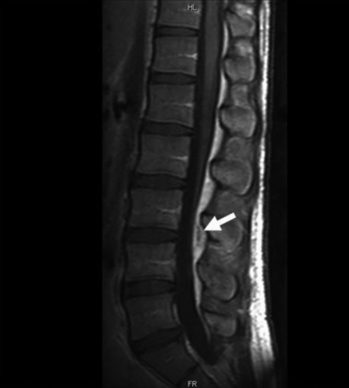 Kontrola MR po 6 dnech ATB.
Fig. 3. Follow-up MR after 6 days of ATB.