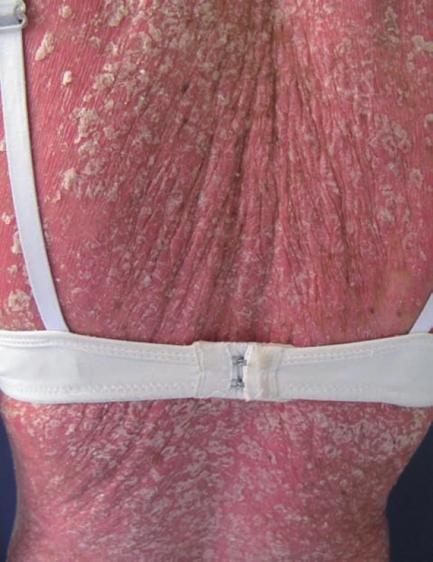 Exacerbace psoriázy, selhání standardní celkové léčby