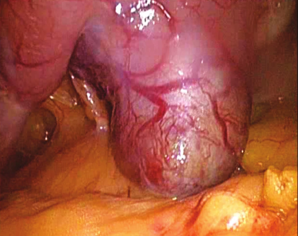 Peroperační snímek GIST zadní stěny žaludku
Fig. 3. Intraoperative view of GIST located within the posterior gastric wall