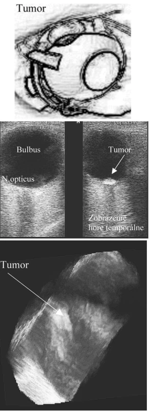 a. Tumor bulbu lokalizovaný v oblasti ekvátoru – schematicke zobrazenie tmavého ložiska v hornej polovine ekvátoru
b. 2D USG zobrazenie intrabulbárneho tumoru v oblasti ekvátoru. Na obrázku vľavo predozadný pohľad od bulbu ku hrotu orbity. Tumor je lokalizovaný v oblasti ekvátoru, preto je zobraziteľný len pri zmene polohy sondy a zmene polohy bulbu
c. 3D USG zobrazenie intrabulbárneho tumoru – časť bulbu v oblasti ekvátoru. Tumor je prekrytý retinou, pri rotácii zobrazenia je uložený v oblasti choroidey. Bez známok trakcie, sekundárnej amócie