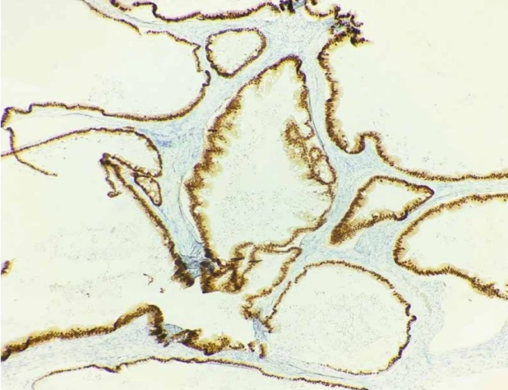 Imunohistochemická pozitivita nádorového žľazového epitelu na CDX2 (zväčšenie objektívu 10×) 