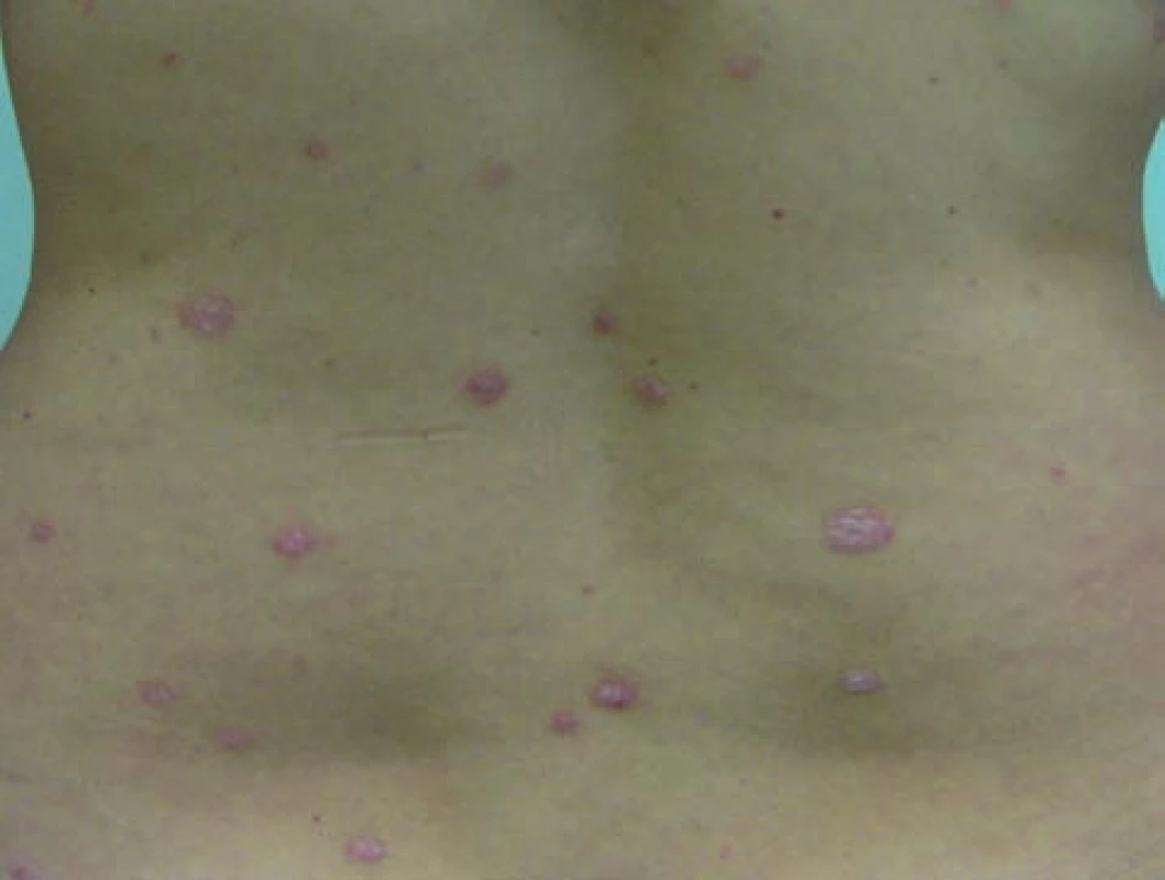 Psoriaziformná kožná erupcia u pacientky s morbus Crohn počas liečby infliximabom imitujúca psoriasis vulgaris