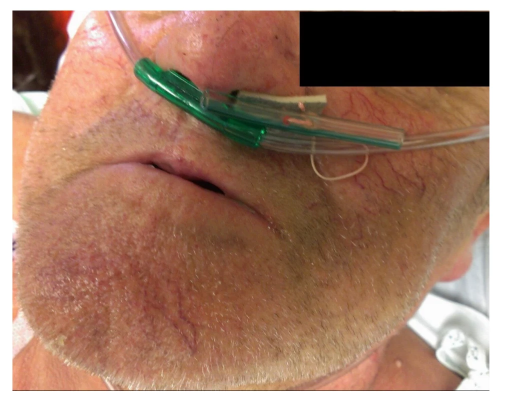 Prevence migrace stentu − ukotvení stentu před
nosní dírkou<br>
Fig. 2: Prevention of stent migration − anchoring of the
stent in front of the nostril