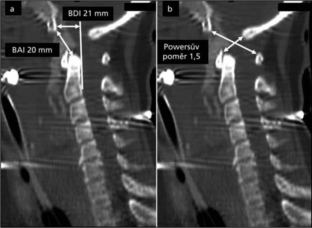 Sagitální rekonstrukce spirálního CT ilustrující:
a) BDI (Basion-Dens Interval), BAI (Basion-Axial Interval); a
b) Powersův poměr. Všechny tři parametry jsou vysoce za přípustnou hranicí. Dále je přítomna krev z přerušené arteria basilaris v oblasti mezi klivem a C2.