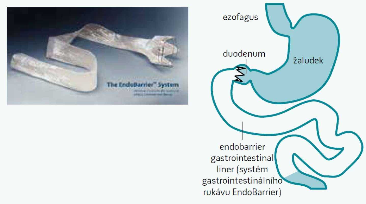 Endoskopicky implantovatelný duodeno-jejunální rukáv