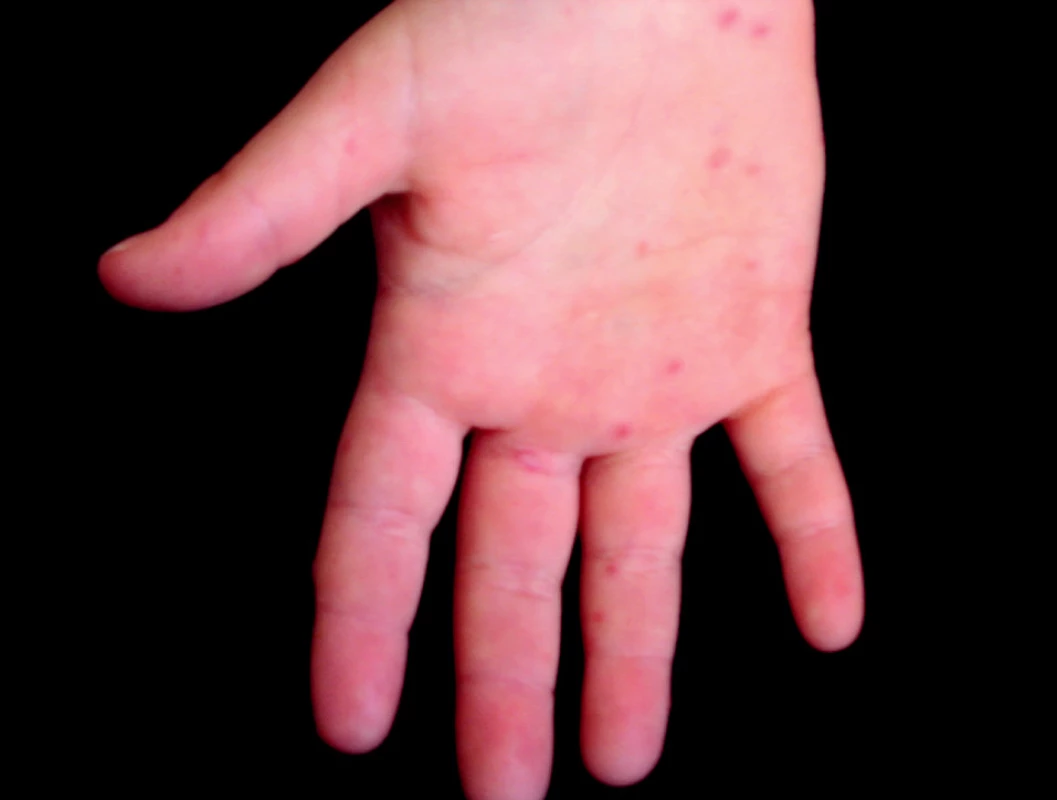 Hand, foot and mouth disease, 5-ročné dievča (enterovírusový exantém)