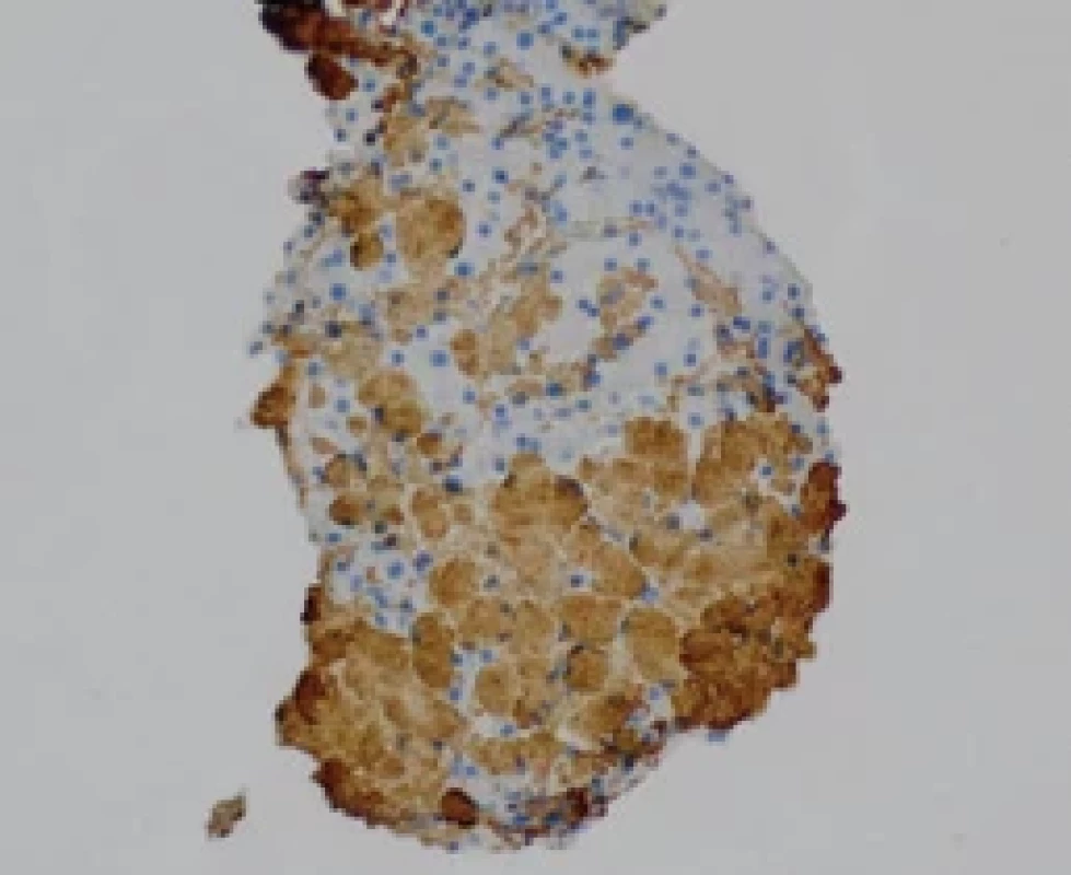 Histologický vzorek jater prezentovaného případu (Ústavu Klinické a Molekulární Patologie LF UP Olomouc). Depozita amyloidu vykazují pozitivitu IgM v imunohistochemickém vyšetření.