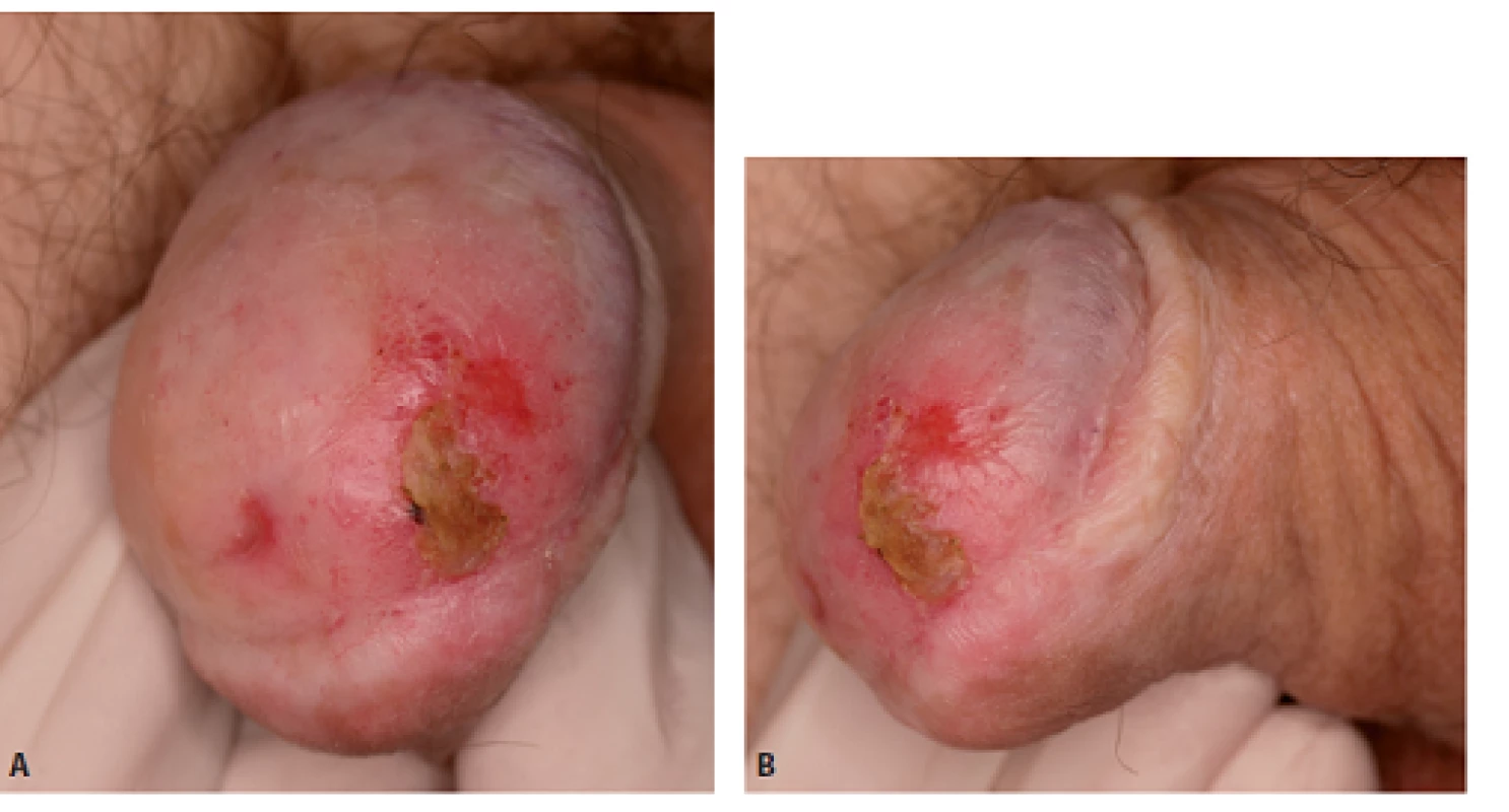 Muž, 62 let, 3 roky po cirkumcizi, histologicky „balanitis xerotica obliterans“ (novou nomenklaturou lichen sclerosus). Nyní biopsie PeIN a dlaždicobuněčný karcinom pT1, provedena glansektomie mj. i pro těžkou stenózu zevního ústí uretry. Defi nitivní histologie pT2G2, pozitivní okraje (čepy tumoru v uretře v oblasti spongiózního tělesa). Proto ve druhé době provedena totální amputace penisu a excize značených sentinelových uzlin, histologie pT0pN0.
Fig. 4. Man, 62-year-old, biopsy – PeIN and squamous cancer pT1. Glansectomy was performed, fi nal histology pT2G2, positive margins in urethra – in corpusa spongiosum.Total amputation and excision of sentinel lymph nodes
followed, histology pT0pN0.