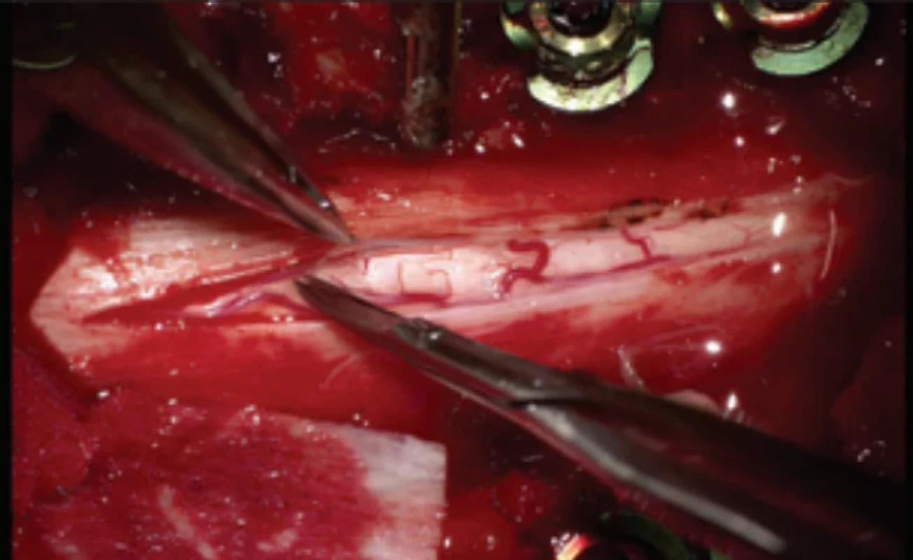 Durální dekomprese míchy z laminiek tomie C4–C6.  Fig. 2. Dural decompression of the spinal cord from a C4–C6 laminectomy. 