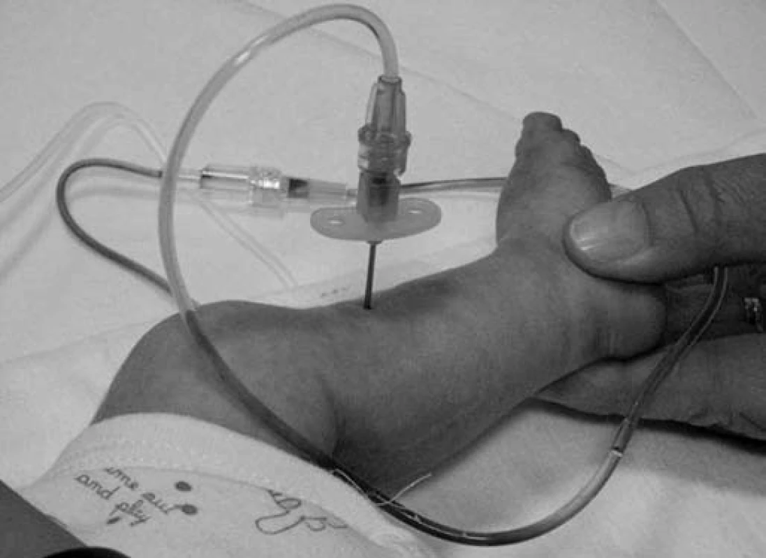 Zavedení intraoseální kanyly pro parenterální rehydrataci. Intraoseální kanyla se zavádí na vnitřní straně tibie, v místě rozhraní její horní a střední třetiny.