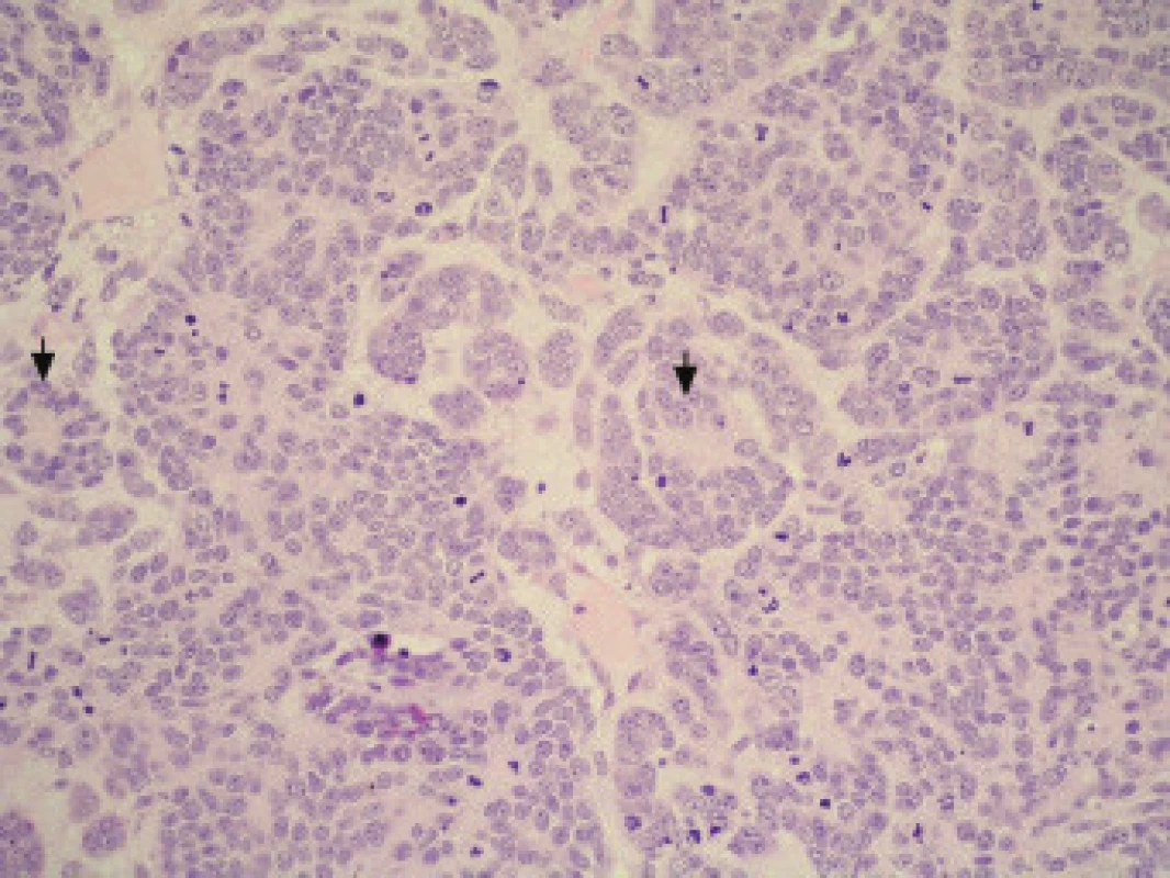 Metastáza velkobuněčného neuroendokrinního karcinomu s početnými mitotickými figurami, zachyceny dvě rozetovité formace (šipky). Barvení HE, zvětšení 200×.