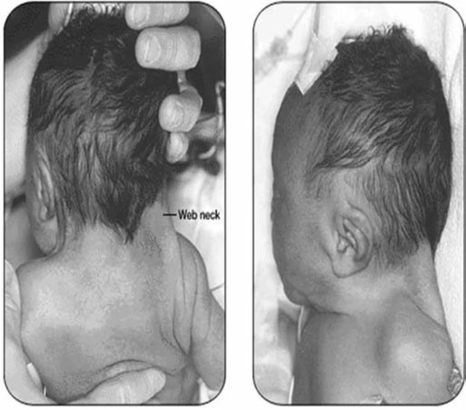 Pterygium colli a nízká vlasová hranice u novorozence (archiv autorů).
Fig. 3. Pterygium colli and low hair border in a newborn (authors’ archive).
