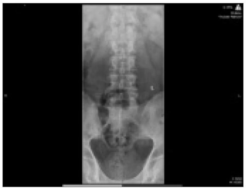 Předozadní a boční snímek páteře pacienta, který byl více než 2 roky v remisi mnohočetného myelomu. Ke svému lékaři přišel pro bolesti v páteři vystřelující do nohou, které se postupně zhoršovaly. Byl odeslán na neurologii, kde dostával klasickou analgetickou a myorelaxační léčbu bez dalšího laboratorního a zobrazovacího došetření. Lékaři k němu přistupovali jako ke každému jinému pacientovi s vertebrogenními potížemi a nerespektovali přítomnost rizikového faktoru, kterým je diagnóza mnohočetný myelom. Teprve až se mu na kalvě objevila hmatná rezistence, byl odeslán na specializované pracoviště, již omezeně chodící a s velmi atrofickými svaly dolních končetin. Akutní MR vyšetření ukázalo teprve příčinu tohoto zhoršení.