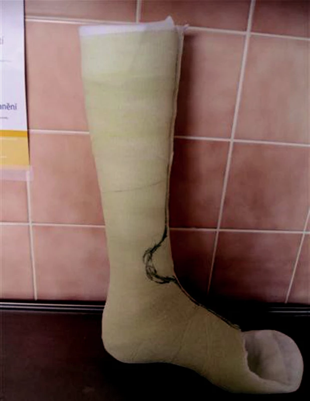 Snímatelná kontaktní fixace (TCC – Total Contact Cast).
