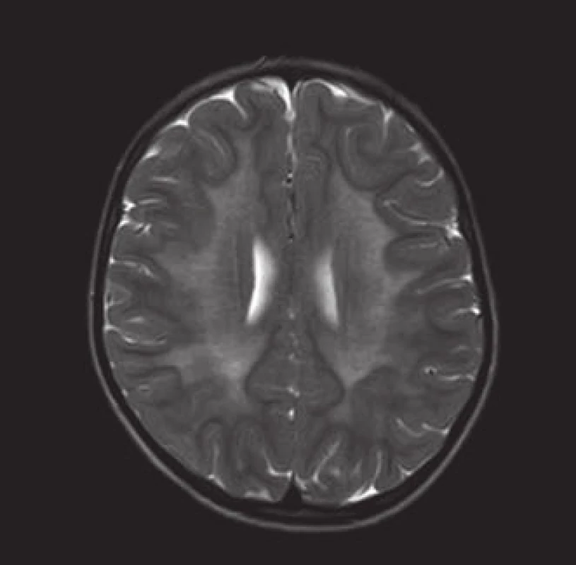 Metachromatická leukodystrofie.
MR vyšetření v T2 zobrazení – symetrické zvýšení intenzity signálu bílé hmoty mozkové.
Fig. 3. Metachromatic leukodystrophy.
T2-weighted MR examination – symmetric increase in signal intensity in the white matter of the brain.