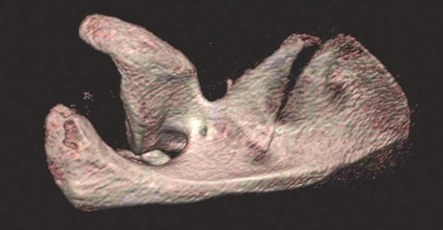 Význam 3D CT rekonstrukcí pro určení typu zlomeniny (v tomto případě transspinózní zlomeniny krčku lopatky: a – rtg snímek levého ramena zachycující zlomeninu, ale nelze určit její anatomii; b – 3D CT rekonstrukce – přední pohled; c – 3D CT rekonstrukce – zadní pohled; d – 3D CT rekonstrukce – pohled do supraspinátní jámy. 
Fig. 4: Importance of 3D CT reconstructions for determination of fracture type (in this case transspinous fracture of scapular neck: a – ap radiograph of left shoulder showing scapular fracture, but its anatomy cannot be identified; b – 3D CT reconstruction – anterior view; c – 3D CT reconstruction – posterior view; d – 3D CT reconstruction – view into supraspinous fossa.