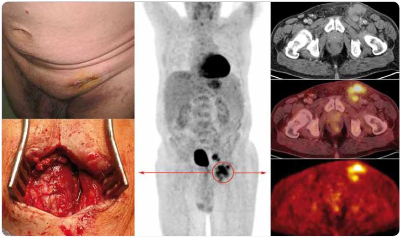 Levostranná tříselná lymfadenopatie u pacienta se smíšenou formou multicentrické Castlemanovy choroby z pohledu internisty, chirurga a radiologa.
Pacient byl vyšetřen na PET/CT (uprostřed nález z celotělové rekonstrukce, vpravo shora dolů high-dose CT, fúze PET/high-dose CT a PET) s nálezem zvětšených a zmnožených lymfatických uzlin na krku, v mediastinu, axilách a retroperitoneu s hraniční aktivitou, v ilických uzlinách a levém třísle pak s jasným hypermetabolizmem glukózy (SUV<sub>max</sub> = 6,15).