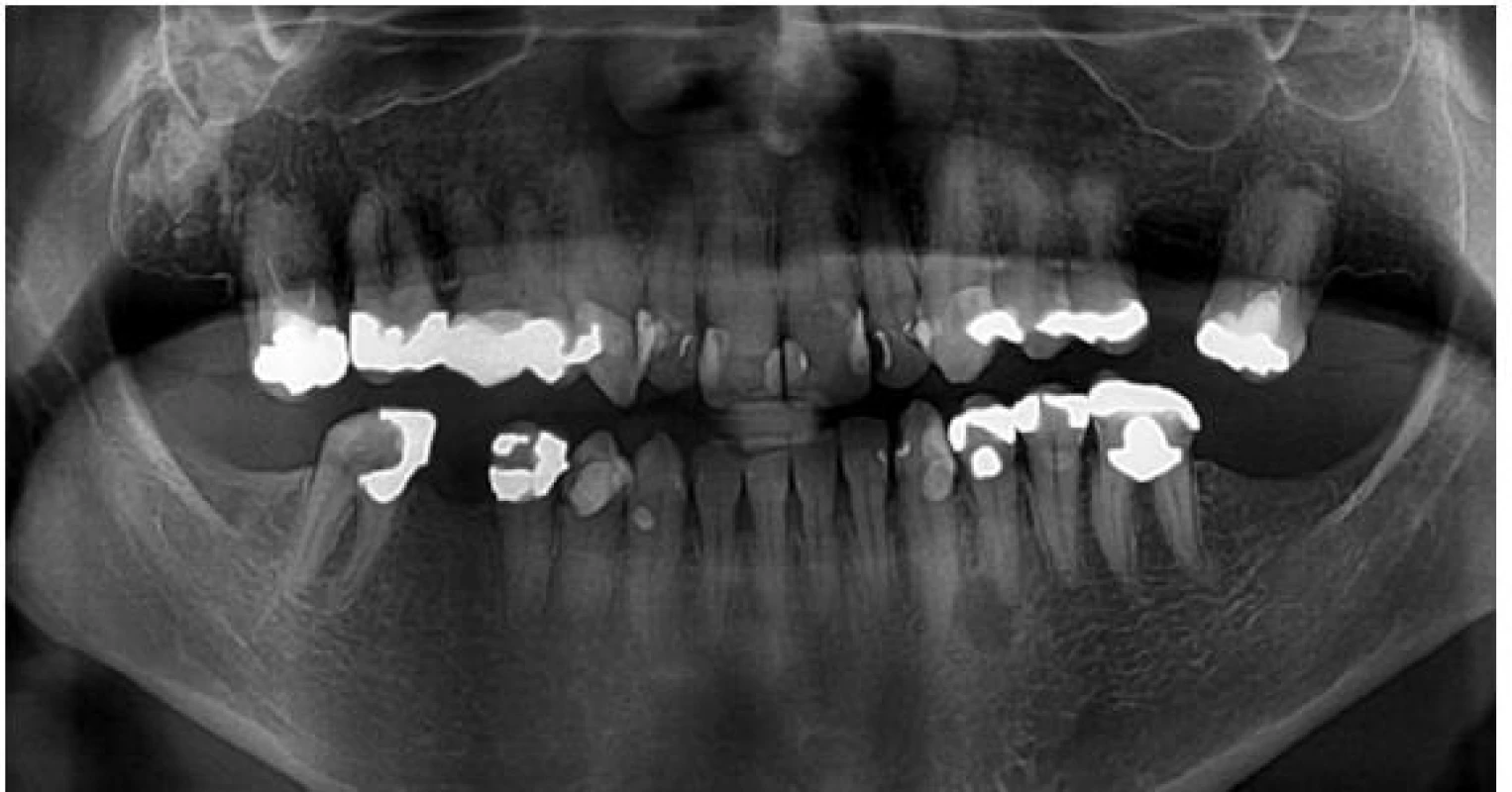 Ortopantomogram pacientky z obr. 5 s nálezem atypicky mohutné mandibuly při akromegalii. Kost jeví normální strukturu, stálý chrup je nekompletní (foto: archiv Stomatologické kliniky LF UK a FN Hradec Králové)