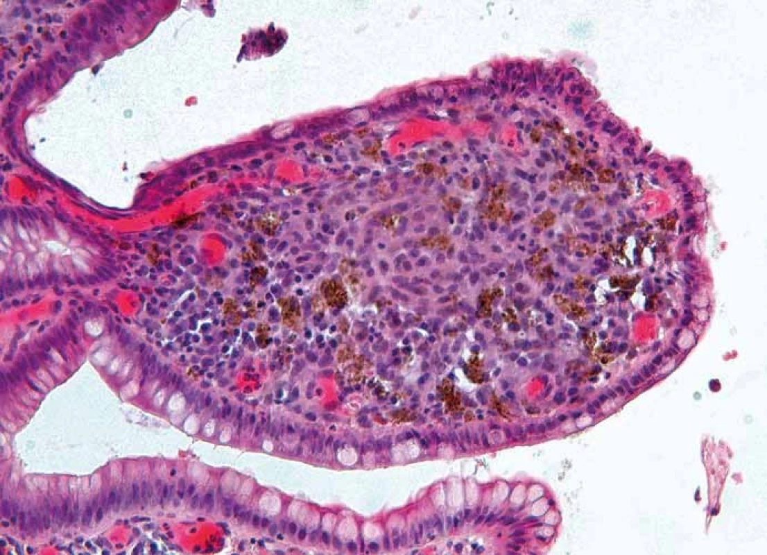 Histopatologický obraz sliznice ilea – střevní klk je téměř kompletně vyplněný atypickými nádorovými melanocyty a četnými roztroušenými melanofágy, barvení hematoxylin-eozinem (zvětšení 100×).
Fig. 6. Histopathologic image of the ileum mucosa – intestinal villus is almost completely filled with atypical neoplastic melanocytes and numerous scattered melanophages, hematoxylin and eosin stain (original magnification ×100).
