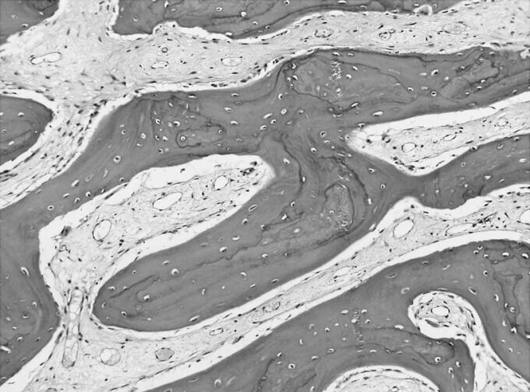 Histologický preparát tkáně, fibrózní dysplazie, HE, 156x.