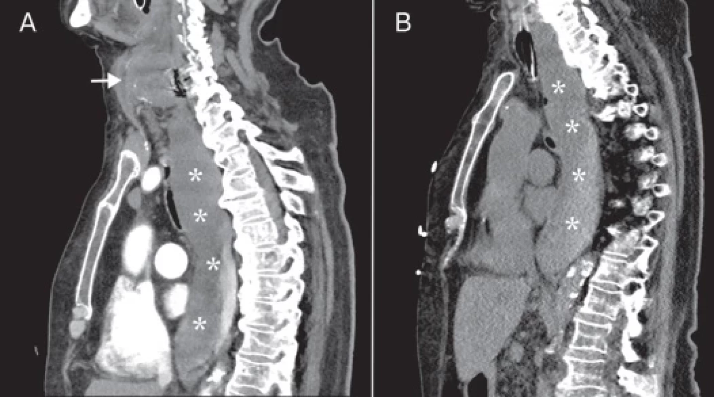 Cervical hematoma before and after surgical revision.