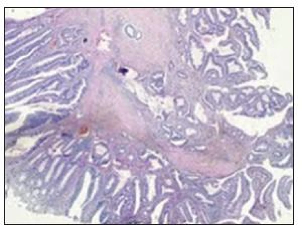 Excízia zo steny hrubého čreva s rozsiahlym intramurálnym hematómom
Fig. 8. Excision from the large intestinal wall with a massive intramural hematoma