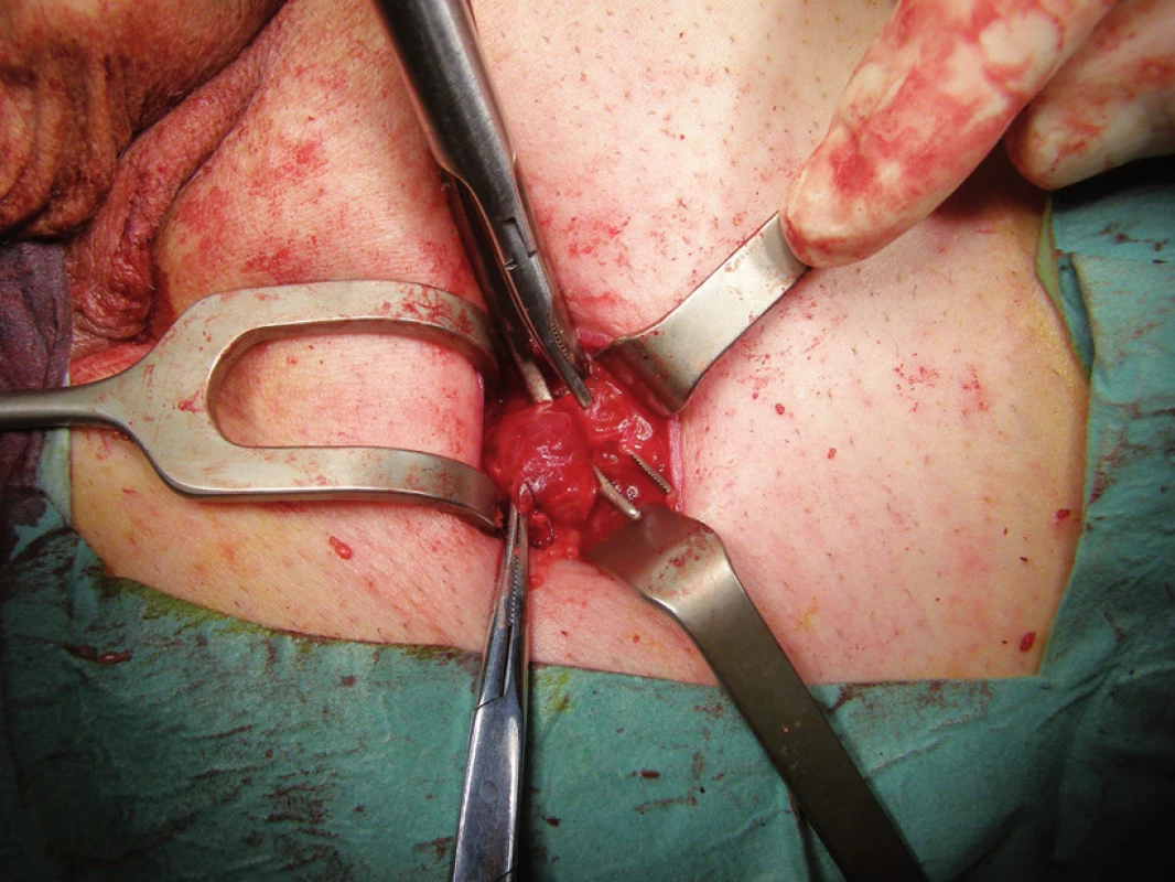 Sentinelová uzlina označená gamakamerou peroperačně
Fig. 3. Sentinel node marked intraoperatively with gamacamera