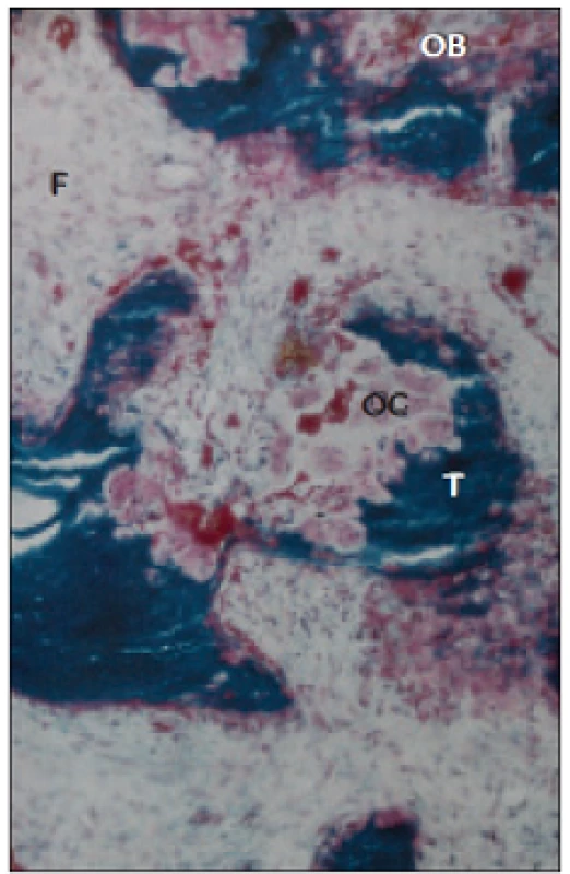 Histologický nález při těžké osteitis fibrosa cystica. Trámčitá kost (T) je zcela nepravidelná, je resorbována mnohojadernými osteoklasty (OC). Osteoblasty (OB) pokrývají povrch resorpční laguny, kterou vyplňují osteoidem. Kostní dřeň je nahrazena fibrózní tkání.