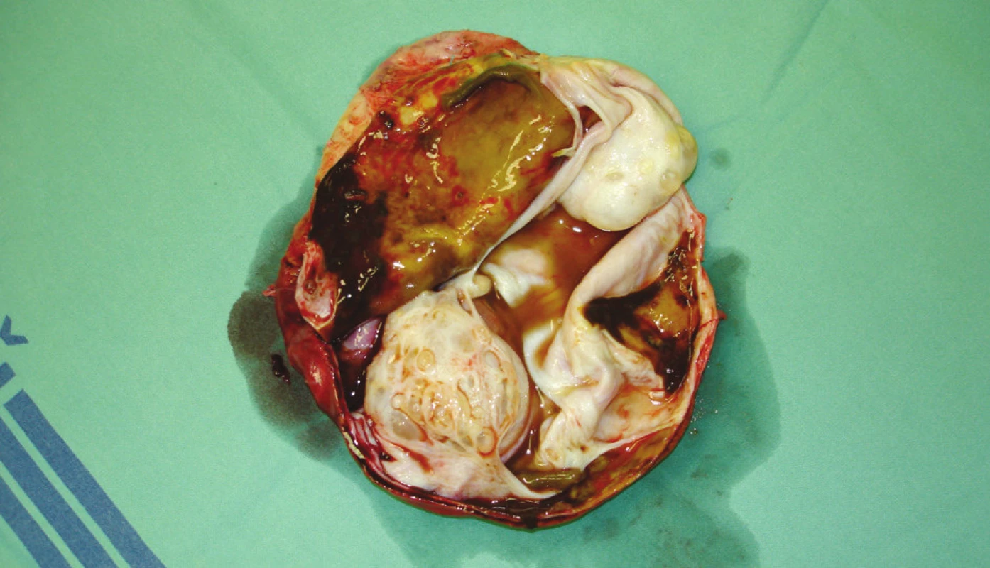 Cystadenom jater – preparát – případ 3 
Photo 3. Liver cystadenoma – a preparation – case No. 3