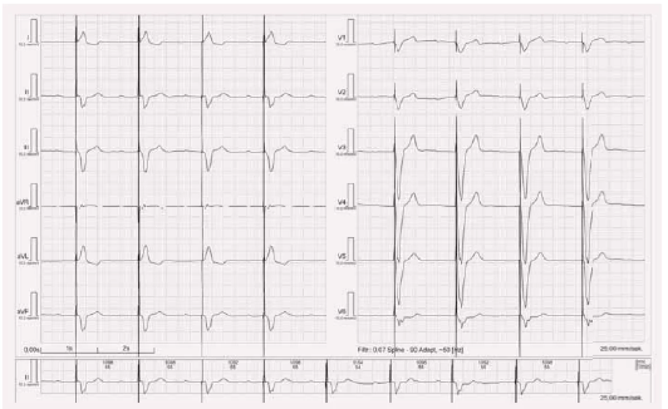 EKG stimulace z hrotu pravé komory unipolární.