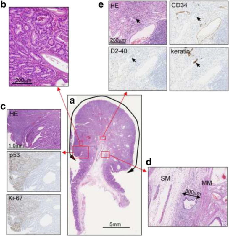 Histological findings. a. Hematoxylin and eosin (HE) staining. b. High magnification image of the boxed area. c. HE, p53, and Ki-67 stainings of the border between the hyperplastic glands and the tumor glands. The tumor lesions were strongly positive for p53 and Ki-67. d. Submucosal invasion in the stalk, with an invasion depth of 300 μm (MM, muscularis mucosae; SM, submucosal layer). e. HE, cluster of differentiation 34 (CD34), D2-40, and keratin staining. In CD34-negative and D2-40-positive lymph ducts, keratin-positive cells with acidophilic cytoplasm and large nuclei were observed, indicating lymphatic invasion (arrows)