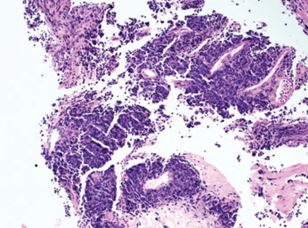 Mikroskopický snímek maligního melanomu příušní žlázy z bioptického vzorku z obr. 1 v barvení hematoxylin-eosin.Micrograph of malignant melanoma of the parotid gland – sample from
Fig. 1 in hematoxylin & eosin stain.