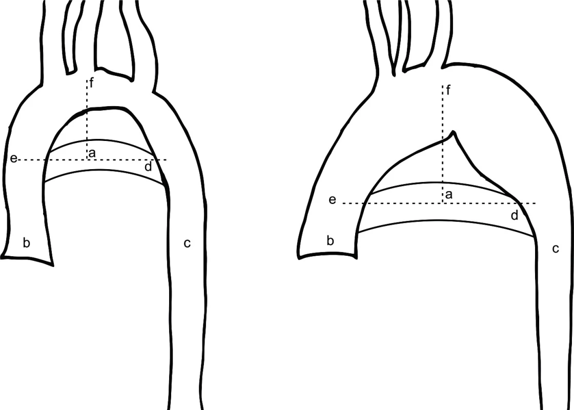 Schématické určení bodu AoHP, vlevo normální nález, vpravo abnormální morfologie aortálního oblouku. (Převzato z De Groote K, Devos D, Van Herck K, et al. Abnormal aortic arch morphology in Turner syndrome patients is a risk factor for hypertension. Heart Vessels 2015; 30: 618–625.)